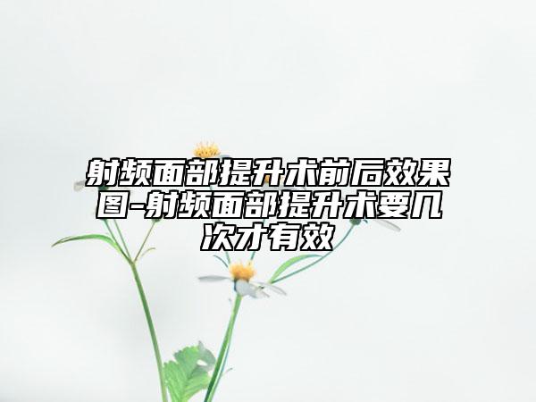 射频面部提升术前后效果图-射频面部提升术要几次才有效